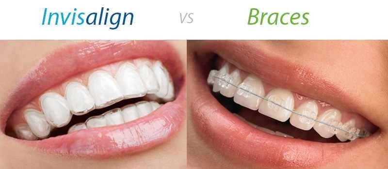 invisible aligners australia