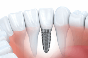 Implants Twenty One dental clinic dentist New Church Road Brighton Hove