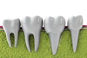 Wisdom teeth Twenty One dental clinic dentist Brighton Hove