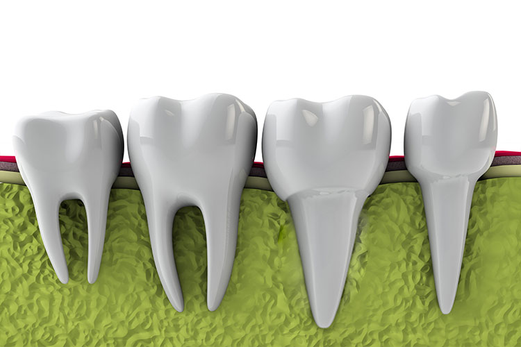 Wisdom teeth Twenty One dental clinic dentist Brighton Hove