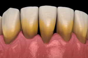 Plaque and tartar Twenty One dental clinic dentist Brighton Hove