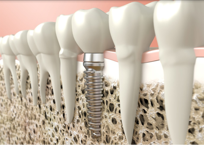 Implants Twenty One dental clinic dentist New Church Road Brighton Hove