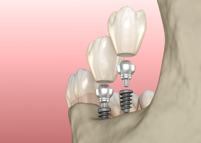 Mini implant Twenty One dental clinic dentist Brighton Hove