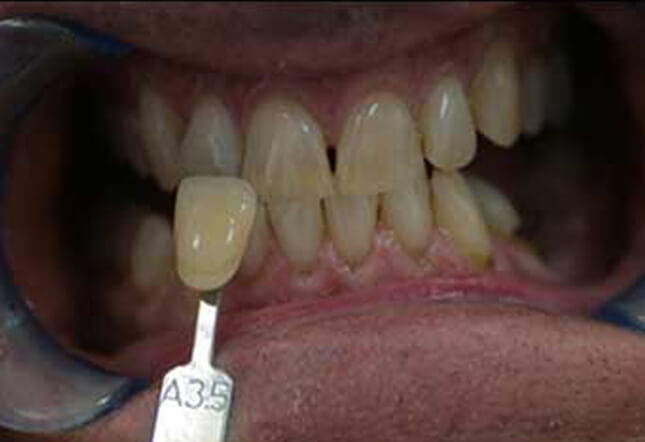 teeth whitening Twenty One dental clinic dentist Brighton Hove