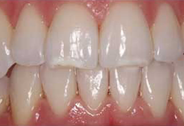 Invisalign©, Teeth Whitening and bonding