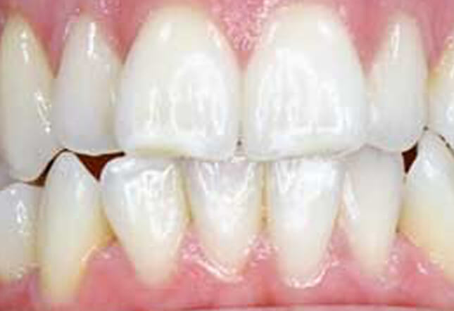 Invisalign©, Teeth Whitening and bonding