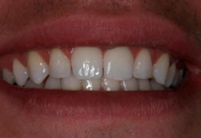 teeth whitening Twenty One dental clinic dentist Brighton Hove