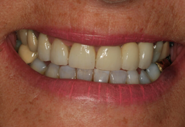 teeth whitening Twenty One dental clinic dentist Brighton Hove