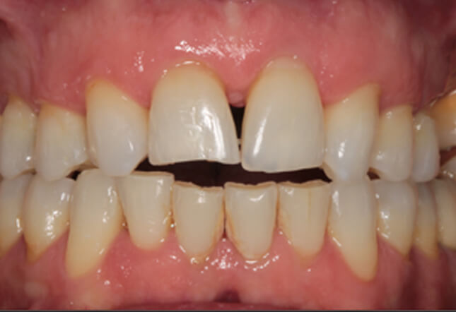 teeth whitening teeth whitening Twenty One dental clinic dentist Brighton Hove