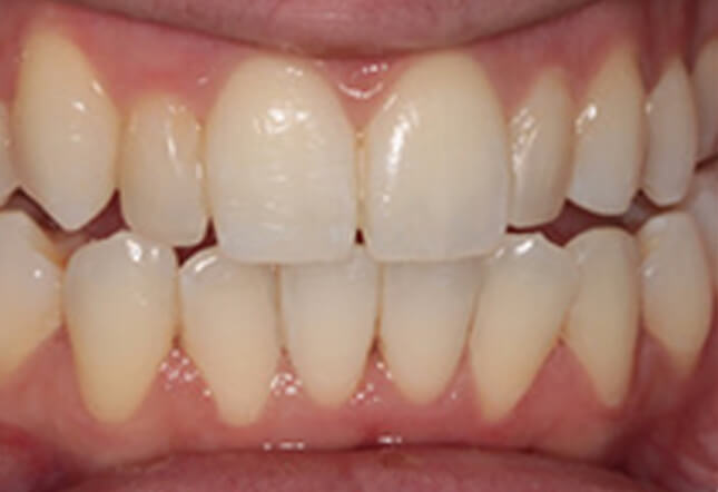 teeth whitening teeth whitening Twenty One dental clinic dentist New Church Road Brighton Hove