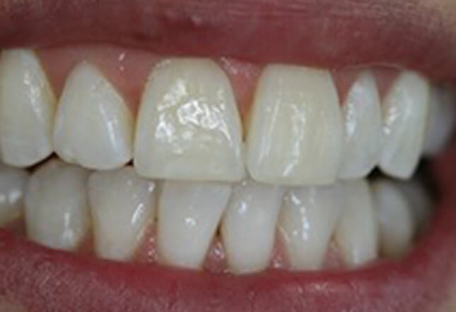teeth whitening Twenty One dental clinic dentist Brighton Hove
