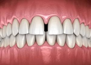 Teeth with a gap in the front