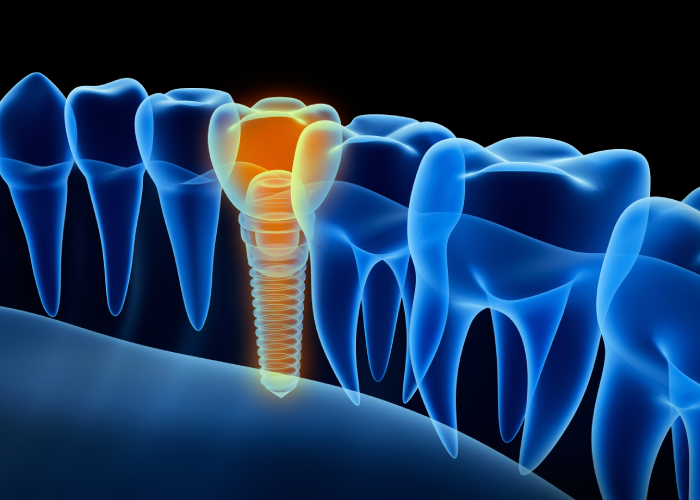 dental implants Twenty one dental clinic dentist Brighton hove