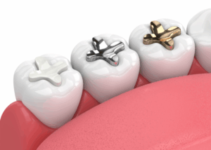 white, silver and gold cavity fillers