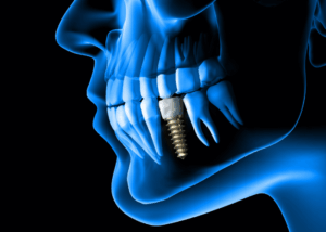 Implant X-ray of the mouth