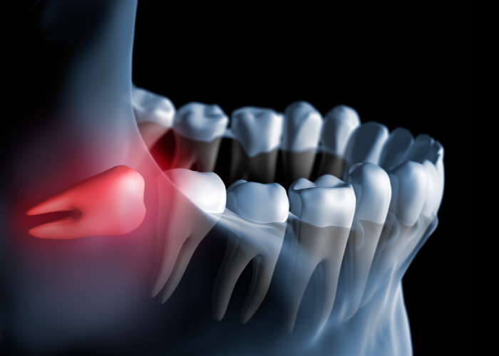 wisdom tooth at an angle