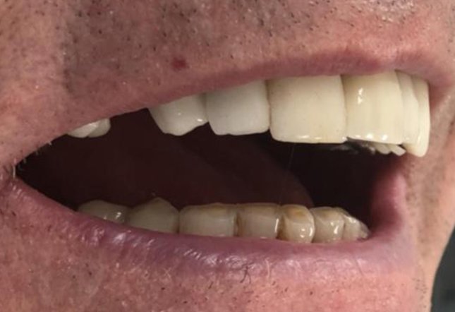 Dental Implants TwentyOneDental Dentist Brighton and Hove