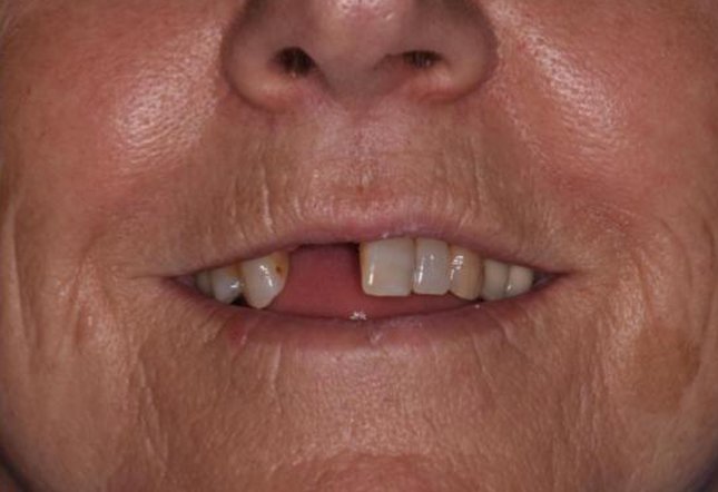Dental Implants TwentyOneDental Dentist Brighton and Hove
