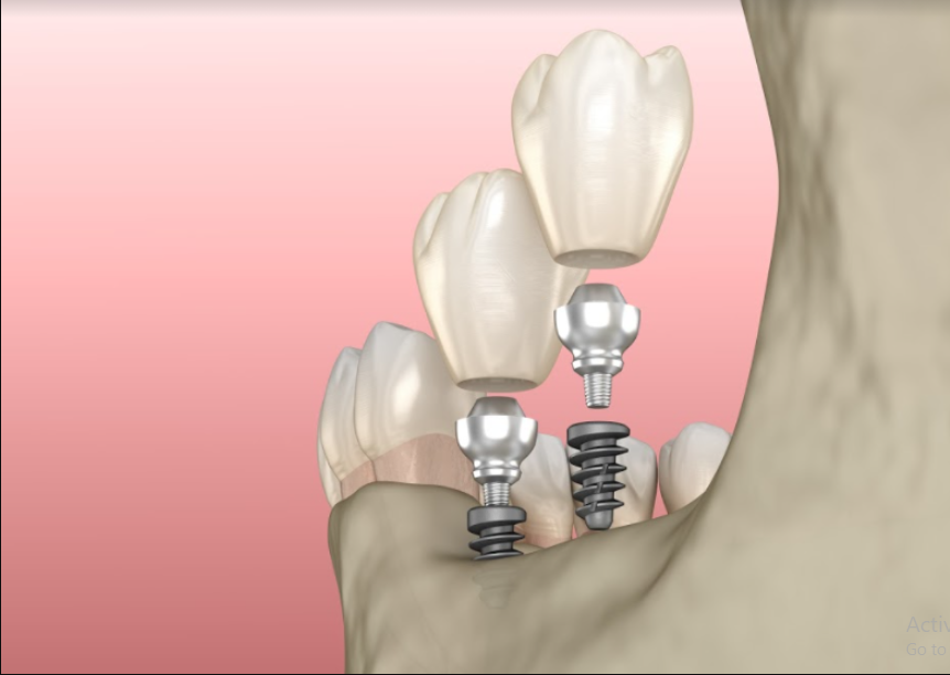 dental implants being secured