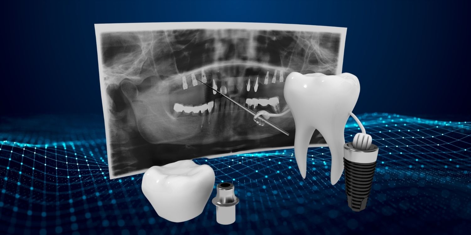 3d dental implant isolated, 3d render illustration - Stock Illustration  [96764935] - PIXTA