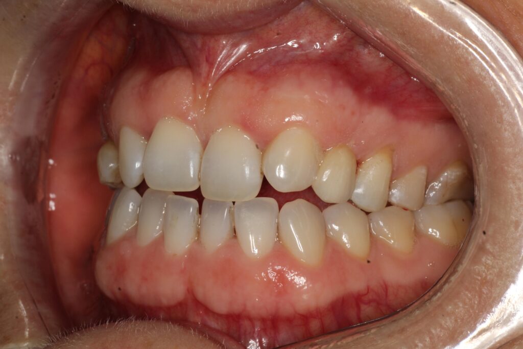 Case 1 after 1 converted