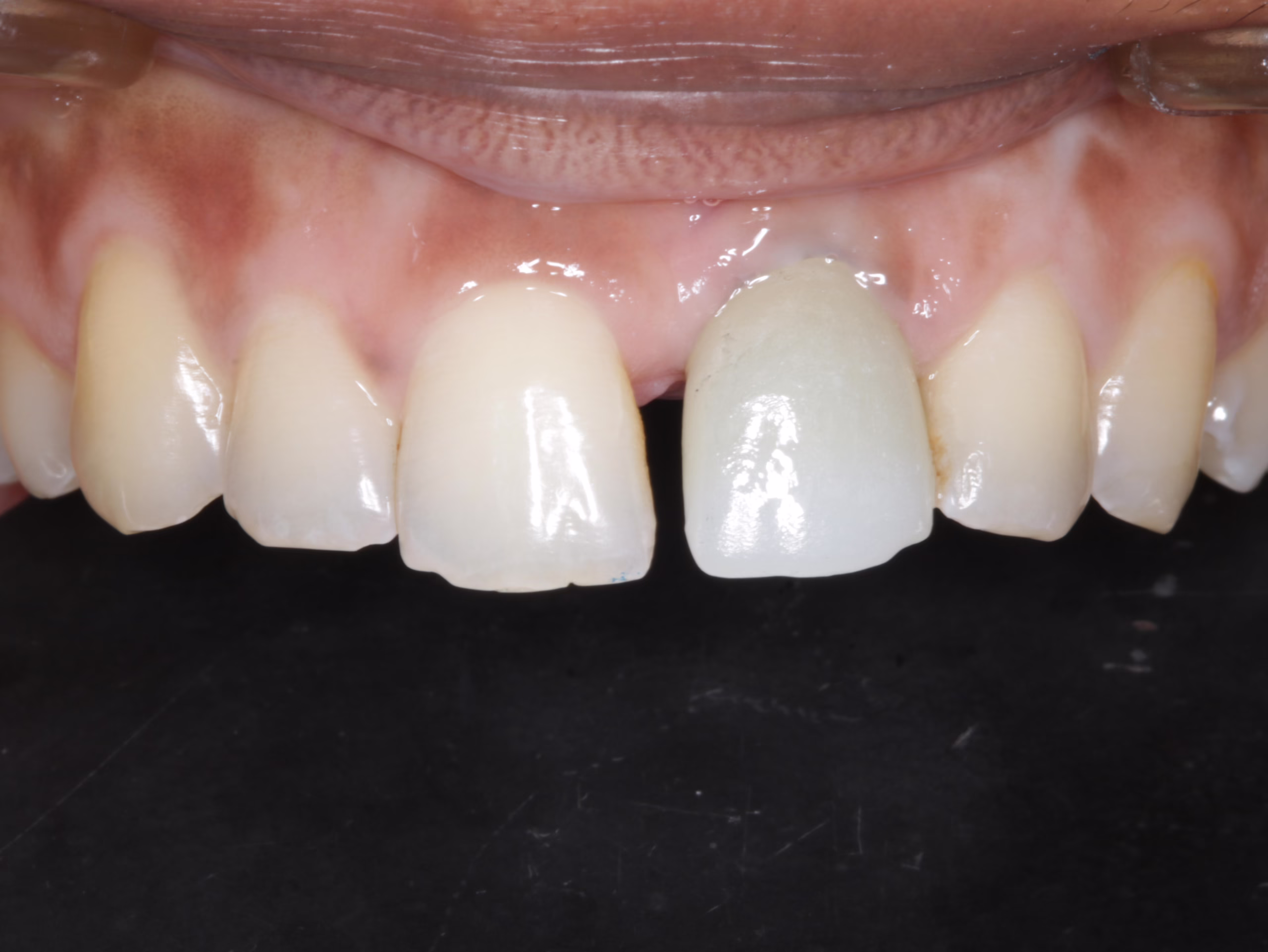 Case 1 after_converted