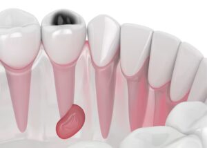 toothdecay