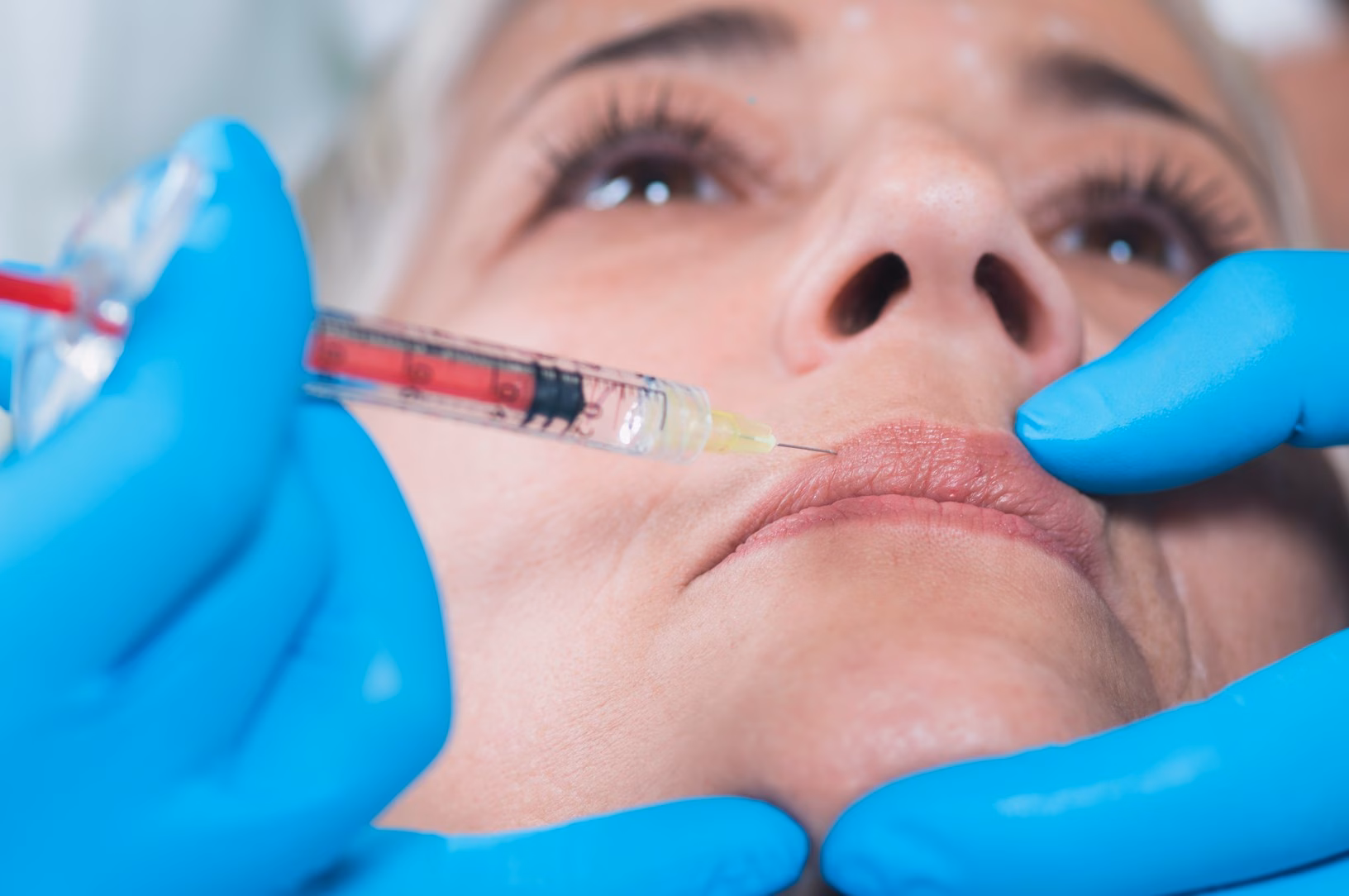 Dermal Fillers in Brighton & Hove