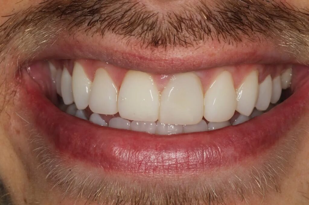 Composite After 2 converted