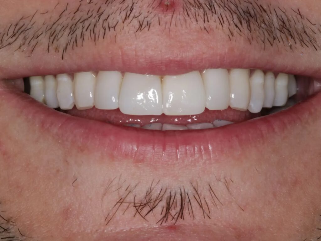 Composite After 3 converted