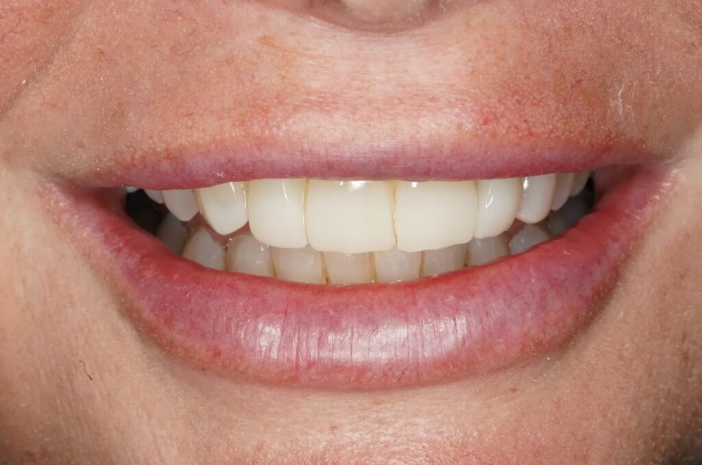 Composite After converted