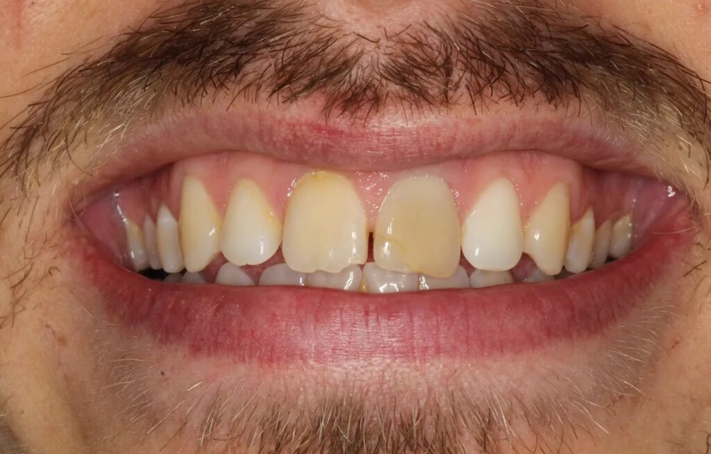 Composite Before 2 converted