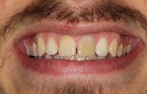 Composite Before 2 converted