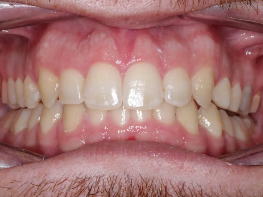 After Aligner converted