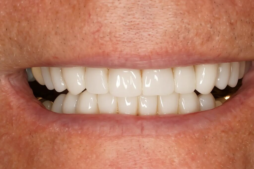 After Bonding converted