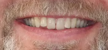 Before Aligners converted e1762840295645