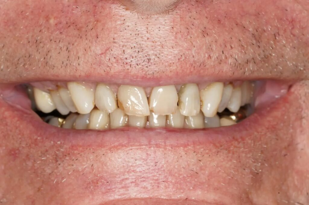 Before Bonding converted