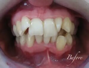 Before Braces 2 converted