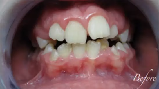 Before Braces 3 converted